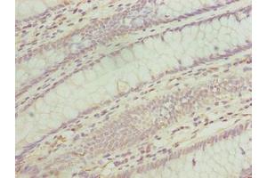 Immunohistochemistry of paraffin-embedded human colon cancer using ABIN7173167 at dilution of 1:100 (TMEM243 anticorps  (AA 1-31))