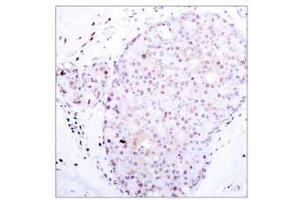 Immunohistochemical analysis of paraffin-embedded human breast carcinoma, using NF-κB p105/p50 (Ab-907) antibody (E021019). (NFKB1 anticorps)