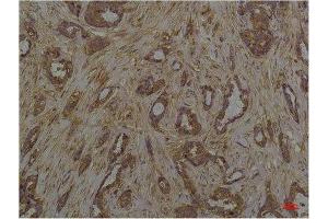 Immunohistochemistry (IHC) analysis of paraffin-embedded Human Breast Caricnoma using Phosphoserine Mouse mAb diluted at 1:200. (Phosphoserine anticorps  (phosphorylated))