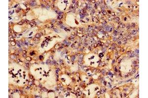 Immunohistochemistry of paraffin-embedded human liver cancer using ABIN7146988 at dilution of 1:100