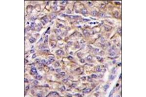 Formalin-fixed and paraffin-embedded human hepatocarcinoma tissue reacted with TAOK3 antibody (C-term), which was peroxidase-conjugated to the secondary antibody, followed by DAB staining. (TAO Kinase 3 anticorps  (C-Term))
