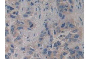Detection of PIK3C3 in Human Breast cancer Tissue using Polyclonal Antibody to Phosphoinositide-3-Kinase Class 3 (PIK3C3) (PIK3C3 anticorps  (AA 631-885))
