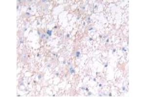 DAB staining on IHC-P; Samples: Human Glioma Tissue. (IFNA5 anticorps  (AA 22-189))