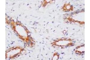 Immunohistochemical analysis of paraffin-embedded cancer sections, staining PP2A in cytoplasm, DAB chromogenic reaction (PPP2CA anticorps  (N-Term))