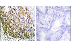 Iunohistochemistry analysis of paraffin-embedded human lung carcinoma tissue using P-10 antibody. (MMP10 anticorps)