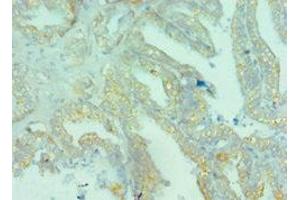 Immunohistochemistry of paraffin-embedded human bladder cancer using ABIN7145824 at dilution of 1:100