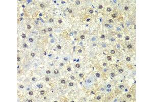Immunohistochemistry of paraffin-embedded Human liver damage using PSMD13 Polyclonal Antibody at dilution of 1:100 (40x lens). (PSMD13 anticorps)