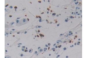 Detection of DEFa4 in Human Stomach cancer Tissue using Polyclonal Antibody to Defensin Alpha 4, Corticostatin (DEFa4)