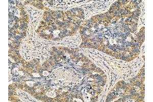 RXFP1 Mouse Monoclonal Antibody at 1/100 staining human lung cancer and adjacent non-tumor tissue by IHC-P.
