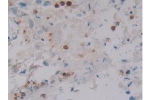 Detection of DEFa4 in Human Breast cancer Tissue using Polyclonal Antibody to Defensin Alpha 4, Corticostatin (DEFa4)