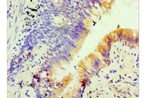 Immunohistochemistry of paraffin-embedded human lung cancer using ABIN7153127 at dilution of 1:100