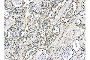TXNDC6 Antibody at 1/100 staining human ovarian cancer by IHC-P. (NME9 anticorps)