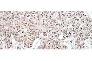 Immunohistochemistry of paraffin-embedded Human prost ate cancer tissue using HNRNPH2 Polyclonal Antibody at dilution of 1:40(x200)