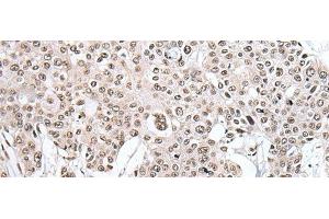 Immunohistochemistry of paraffin-embedded Human prost ate cancer tissue using HNRNPH2 Polyclonal Antibody at dilution of 1:40(x200) (HNRNPH2 anticorps)