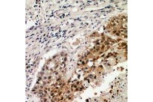 Immunohistochemical analysis of VEGFR3 staining in human lung formalin fixed paraffin embedded tissue section. (FLT4 anticorps)