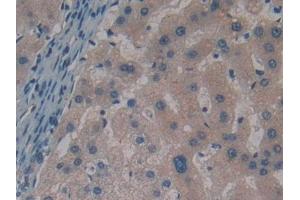 Detection of SNCG in Human Liver cancer Tissue using Polyclonal Antibody to Gamma-synuclein (SNCG)