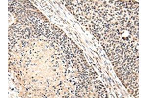The image on the left is immunohistochemistry of paraffin-embedded Human esophagus cancer tissue using ABIN7131587(VPS41 Antibody) at dilution 1/20, on the right is treated with fusion protein. (VPS41 anticorps)