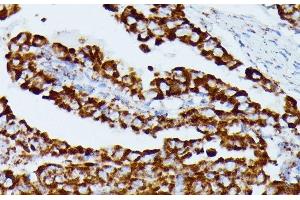Immunohistochemistry of paraffin-embedded Human thyroid cancer using IDH3A Polyclonal Antibody at dilution of 1:100 (40x lens). (IDH3A anticorps)