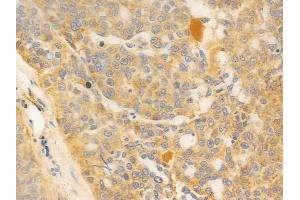 ABIN6259847 and ABIN6277044 at 1/100 staining human ovarian carcinoma by IHC-P. (AK4 anticorps  (Internal Region))