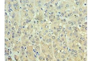 Immunohistochemistry of paraffin-embedded human liver cancer using ABIN7143649 at dilution of 1:100 (ADH1C anticorps  (AA 1-375))