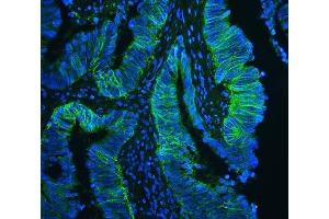 IF analysis of CD147/Emmprin using anti-CD147/Emmprin antibody (ABIN5518743) CD147/Emmprin was detected in paraffin-embedded section of human intestinal cancer tissues.