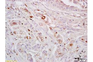 Formalin-fixed and paraffin embedded human lung carcinoma labeled with Rabbit Anti EPH receptor A4 Polyclonal Antibody, Unconjugated (ABIN734123) at 1:200 followed by conjugation to the secondary antibody and DAB staining (EPH Receptor A4 anticorps  (AA 531-630))