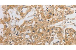 Immunohistochemistry of paraffin-embedded Human lung cancer tissue using HCRTR2 Polyclonal Antibody at dilution 1:50 (HCRTR2 anticorps)