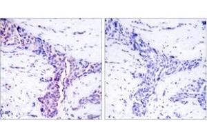 Immunohistochemistry analysis of paraffin-embedded human breast carcinoma tissue, using ATF2 (Ab-73 or 55) Antibody. (ATF2 anticorps  (AA 40-89))