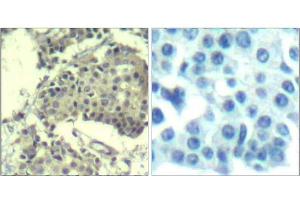 Immunohistochemical analysis of paraffin-embedded human breast carcinoma tissue using mTOR (Ab-2481) Antibody (E021515).