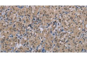Immunohistochemistry of paraffin-embedded Human thyroid cancer tissue using MGLL Polyclonal Antibody at dilution 1:40 (MGLL anticorps)