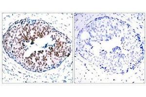 Immunohistochemical analysis of paraffin-embedded human breast carcinoma tissue using STAT5A(Phospho-Ser780) Antibody(left) or the same antibody preincubated with blocking peptide(right). (STAT5A anticorps  (pSer780))