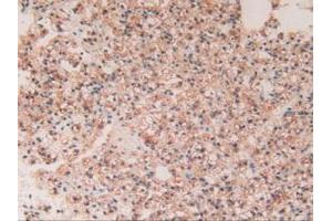 IHC-P analysis of Human Kidney Cancer Tissue, with DAB staining.