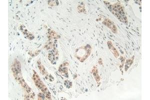 Detection of HMGB1 in Human Breast cancer Tissue using Polyclonal Antibody to High Mobility Group Protein 1 (HMGB1)