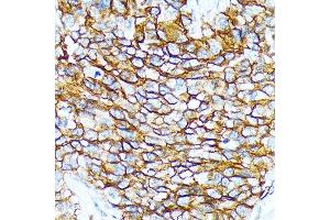 Immunohistochemistry of paraffin-embedded human oophoroma using CD239/BCAM Rabbit mAb (ABIN7265828) at dilution of 1:100 (40x lens).