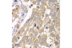 Immunohistochemistry of paraffin-embedded human esophageal cancer using PFKM antibody at dilution of 1:100 (x40 lens). (PFKM anticorps)