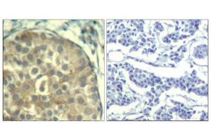 Immunohistochemical analysis of paraffin-embedded human breast carcinoma tissue using cofilin1/cofilin2(Phospho-Tyr88) Antibody(left) or the same antibody preincubated with blocking peptide(right). (Cofilin1/2 (CFL1/2) (pTyr88) anticorps)