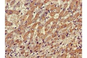 Immunohistochemistry of paraffin-embedded human liver cancer using ABIN7175883 at dilution of 1:100 (XBP1 anticorps  (AA 1-167))