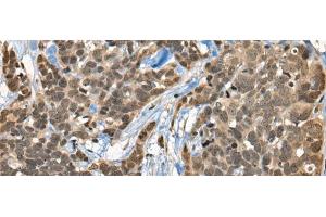 Immunohistochemistry of paraffin-embedded Human thyroid cancer tissue using CBFA2T3 Polyclonal Antibody at dilution of 1:45(x200) (CBFA2T3 anticorps)
