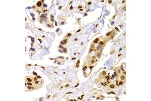 Immunohistochemistry of paraffin-embedded human breast cancer using HNRNPA1 Antibody (ABIN5975570) at dilution of 1/100 (40x lens). (HNRNPA1 anticorps)
