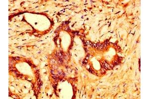 IHC image of ABIN7164465 diluted at 1:500 and staining in paraffin-embedded human colon cancer performed on a Leica BondTM system.