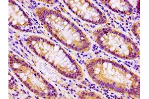 IHC image of ABIN7171142 diluted at 1:100 and staining in paraffin-embedded human colon cancer performed on a Leica BondTM system.