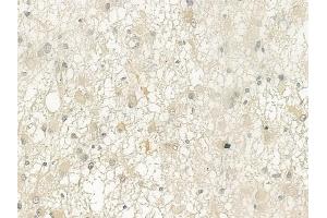 ABIN6265360 and ABIN6276804 at 1/100 staining human astrocytoma by IHC-P. (TAC1 anticorps  (N-Term))