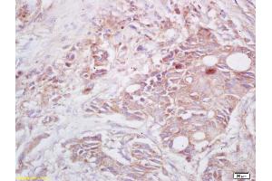 Formalin-fixed and paraffin embedded human lung carcinoma labeled with Rabbit Anti Cryopyrin/CIAS1/NALP3 Polyclonal Antibody, Unconjugated (ABIN1386361) at 1:200 followed by conjugation to the secondary antibody and DAB staining