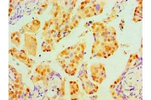 Immunohistochemical of paraffin-embedded Human lung cancer tissue using ABIN7172317 at dilution of 1:200.