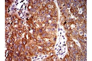 Immunohistochemical analysis of paraffin-embedded ovarian cancer tissues using UFD1L mouse mAb with DAB staining.