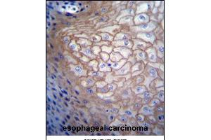 CDCA8 Antibody (N-term) (ABIN656687 and ABIN2845924) immunohistochemistry analysis in formalin fixed and paraffin embedded human esophageal carcinoma followed by peroxidase conjugation of the secondary antibody and DAB staining. (CDCA8 anticorps  (N-Term))