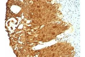 Formalin-fixed, paraffin-embedded human cervical carcinoma stained with Cytokeratin 19 antibody (KRT19/799 + KRT19/800) (Cytokeratin 19 anticorps)