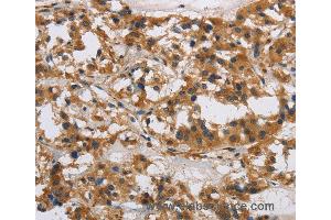 Immunohistochemistry of Human gastric cancer using IL17RB Polyclonal Antibody at dilution of 1:40 (IL17 Receptor B anticorps)