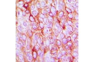 Immunohistochemical analysis of TGF alpha staining in human breast cancer formalin fixed paraffin embedded tissue section. (TGFA anticorps  (C-Term))