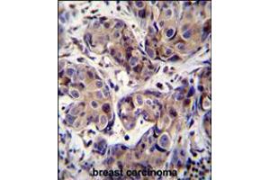 MAGEA3 Antibody immunohistochemistry analysis in formalin fixed and paraffin embedded human breast carcinoma followed by peroxidase conjugation of the secondary antibody and DAB staining. (MAGEA3 anticorps  (C-Term))